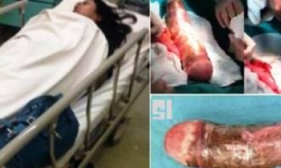 Mulher usa mandioca de 30 cm para se masturbar e vai parar no hospital